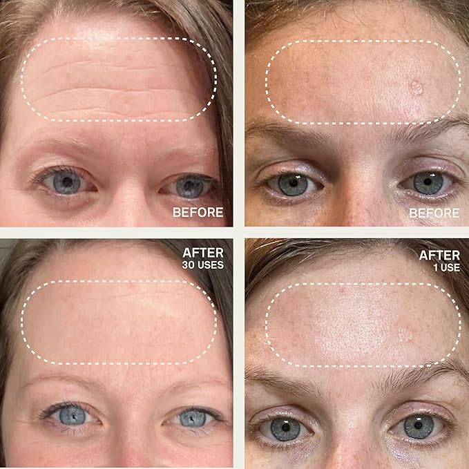 Dermaclara Silicone Facial Patches - Anti-Wrinkle Face Patches for Frown, Smile Lines & Forehead, Reusable Overnight Silicone Wrinkle Pads, Up to 30 Uses - 4 Under Eye Patches & 1 Forehead Patch-VivaGrace Women