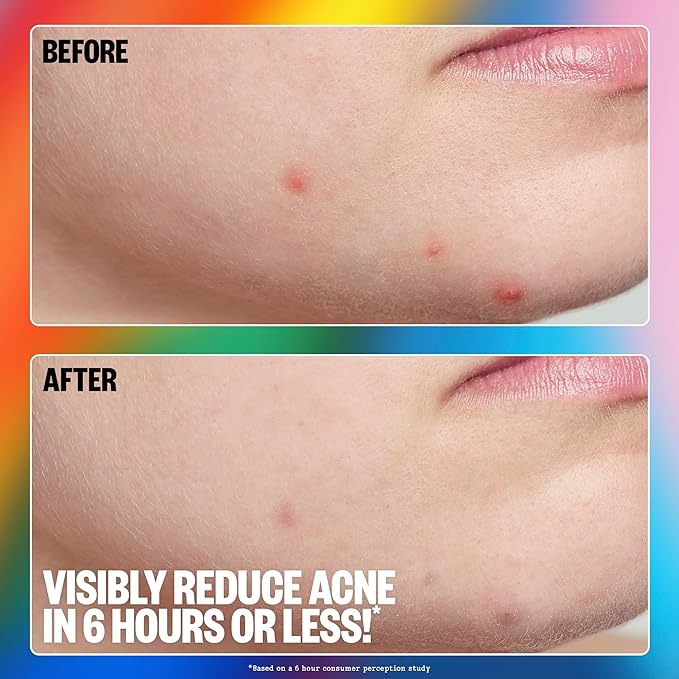 PEACE OUT Acne Healing Pride Dots Helps Clear Blemishes Overnight, Fast Acting Hydrocolloid Pimple Patches for Breakouts with Salicylic Acid, Retinol and Aloe Vera, Award Winning Skincare 16 Count-VivaGrace Women