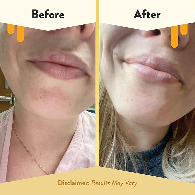 ECZEMA HONEY Nourishing Lip Balm - Organic Chapstick for Sensitive Skin - Daily Lip Moisturizer for Very Dry Lips - Mango Butter & Honey Lip Balm - Natural Lip Care Products (1 Ct)-VivaGrace Women