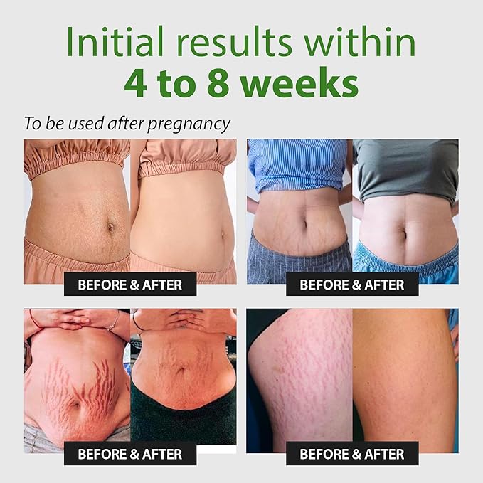 Abera Ovela Maternity Stretch Mark Cream for Pregnancy and Weight Fluctuations, Stretch Mark Treatment Pregnancy Must Haves, Deep Stretch Mark Removal, All Skin Types, 1.69 fl oz-VivaGrace Women