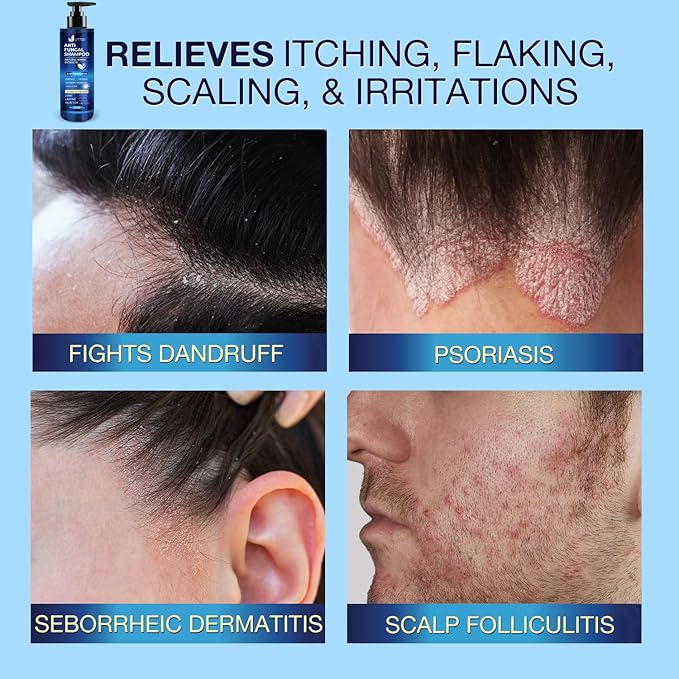 Anti-Fungal Shampoo for Scalp Psoriasis: Dandruff Shampoo for Folliculitis and Seborrheic Dermatitis - Relieves Itchy & Dry Scalp - 300 mL / 10.1 fl.oz-VivaGrace Women