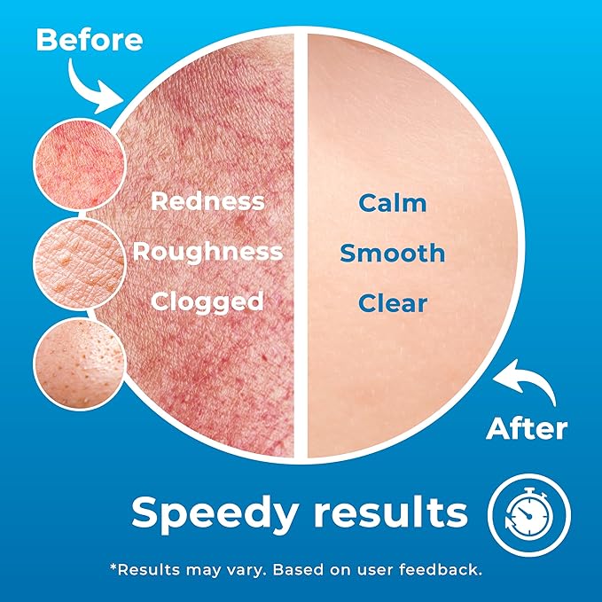 Hypochlorous Acid Spray (8oz, 2 packs), HOCL Facial Cleanser Acne Spray for Face, Body, Eczema, Pimples, Breakouts & Overall Skin Recovery (Reduces Redness)-VivaGrace Women