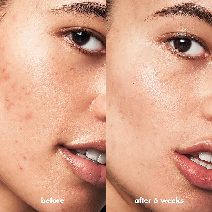 e.l.f. SKIN Blemish Breakthrough Acne Fighting Spot Gel, Roll-on For Treating Blemishes, Made With Salicylic Acid, Vegan & Cruelty-Free