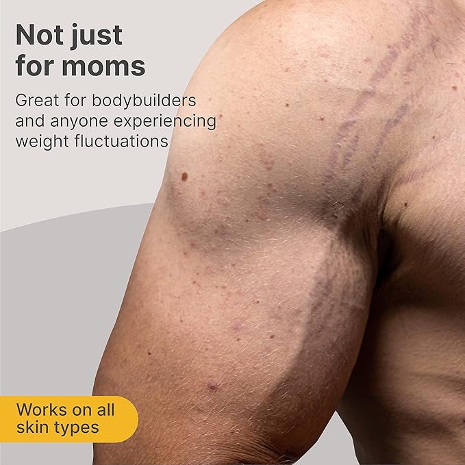 TriLASTIN-SR Intensive Stretch Mark Cream (5.5oz) Bundle with Nipple & Lip Balm (3pk) | Fast-Acting Stretch Marks Cream with Absorption Enhancing Serum | Breastfeeding & Ingesting Safe Balm-VivaGrace Women