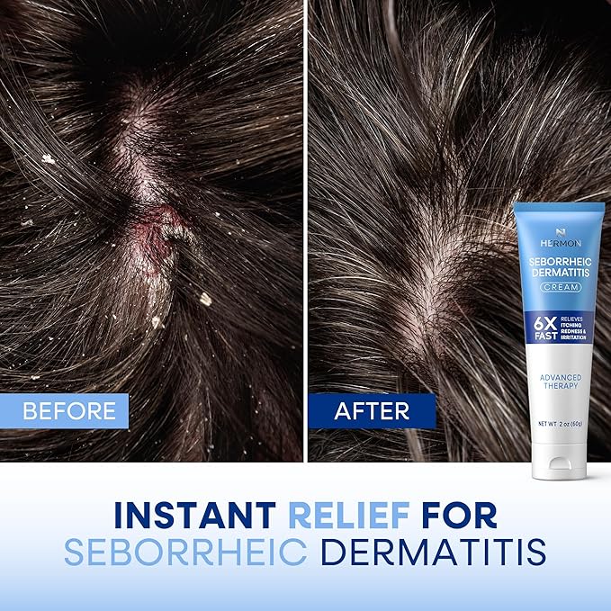 Seborrheic Dermatitis Scalp Treatment Cream: Soothing Itching Redness Scaling of Seborrheic Dermatitis - Fast-Acting Anti-Itch Ointment for Scalp Face Chest and Body for Men and Women 1 Pack-VivaGrace Women